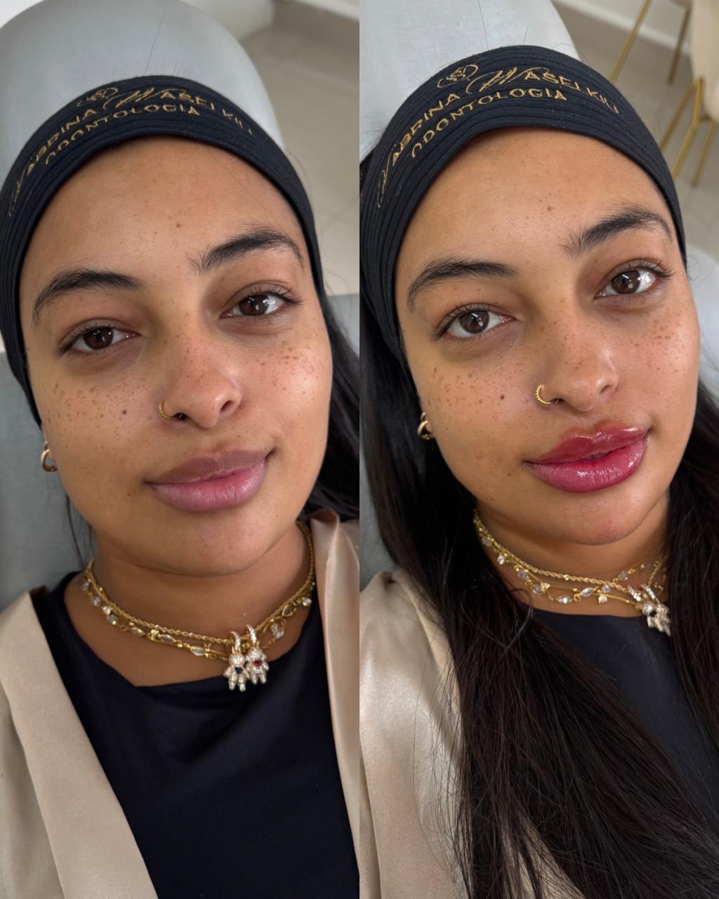 Antes e depois — Preenchimento Labial com a Dra. Sabrina Waselkiu