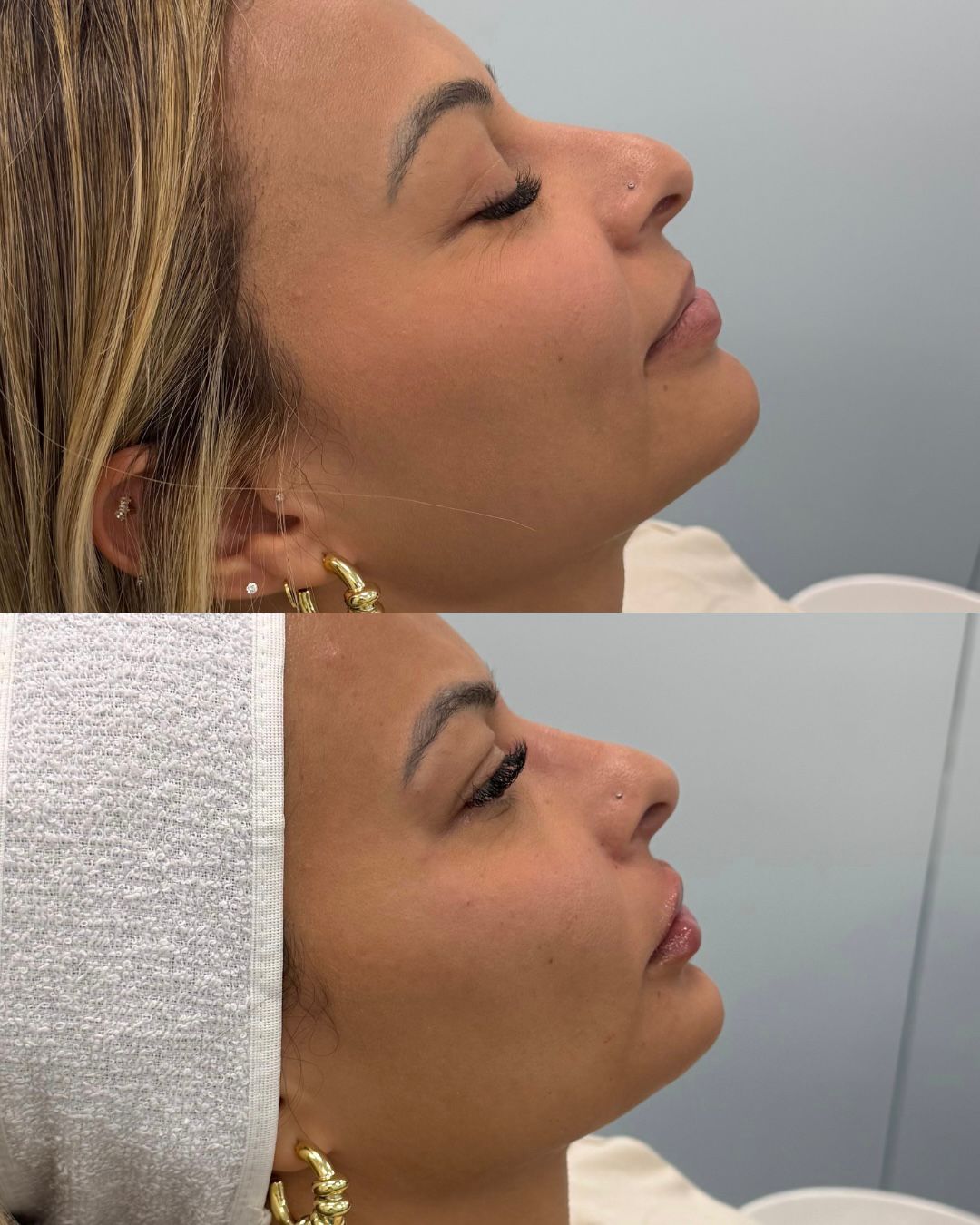 Antes e depois — Rinomodelação com a Dra. Sabrina Waselkiu