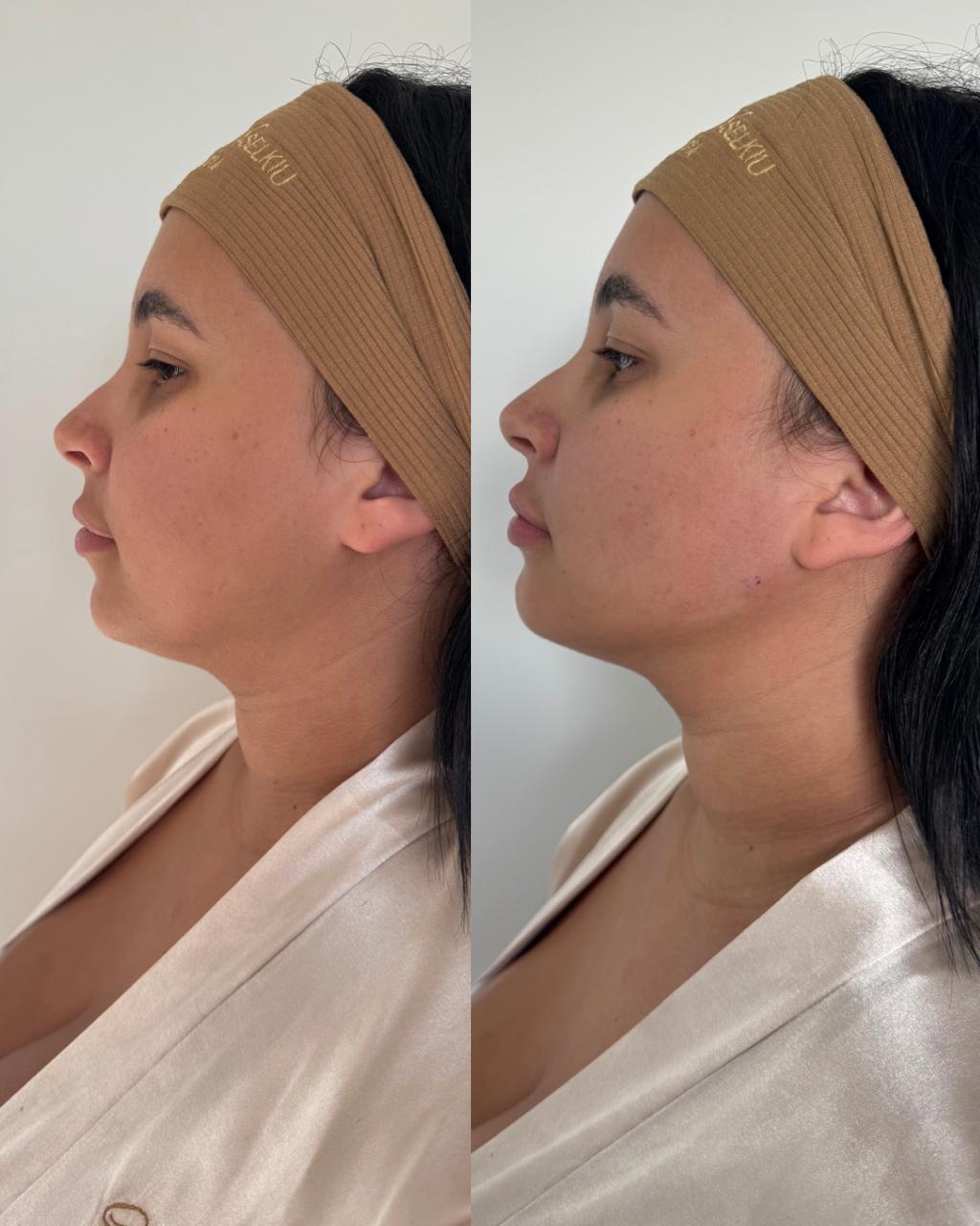 Antes e depois — Papada e contorno de mandíbula com a Dra. Sabrina Waselkiu