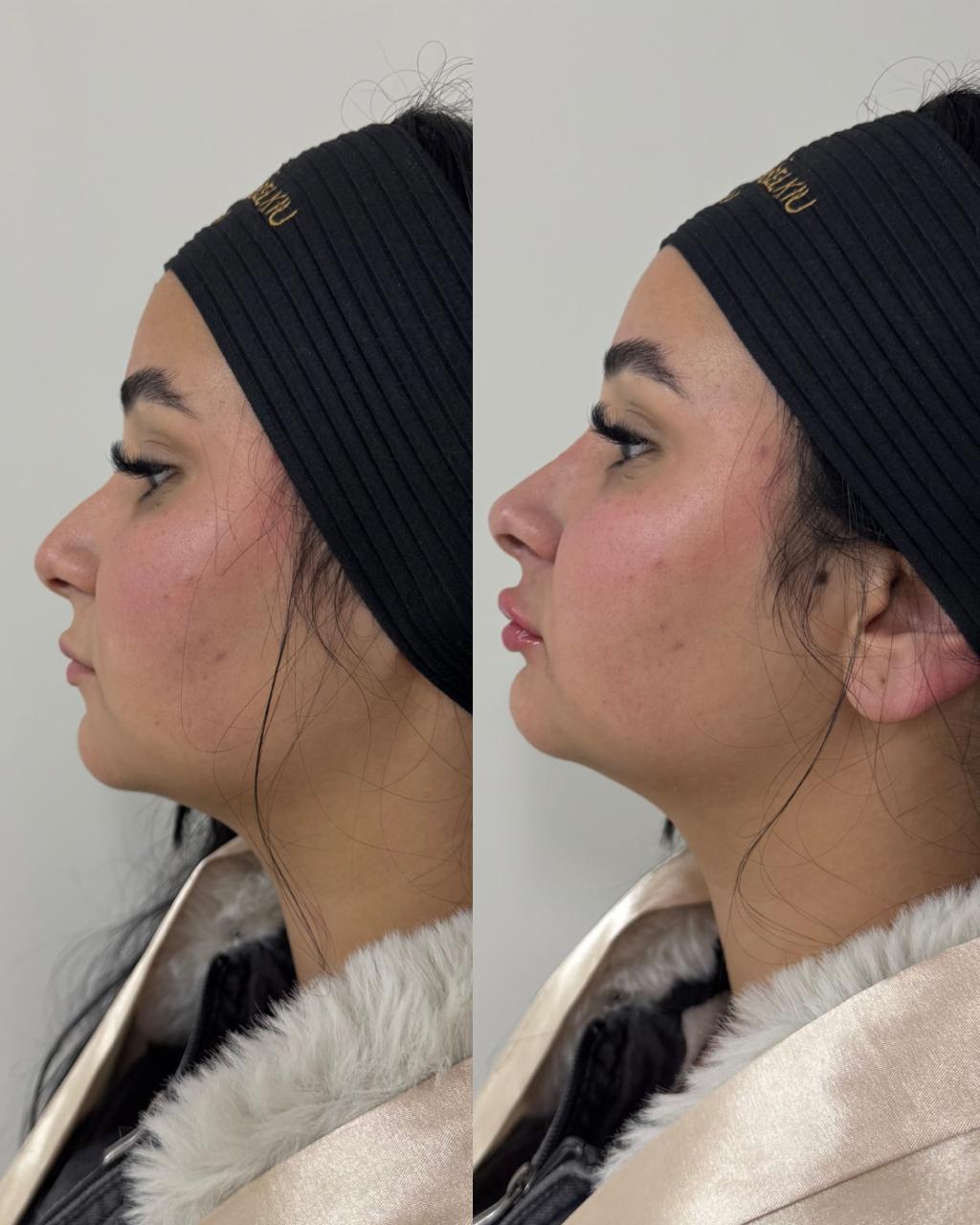Antes e depois — Perfiloplastia com a Dra. Sabrina Waselkiu