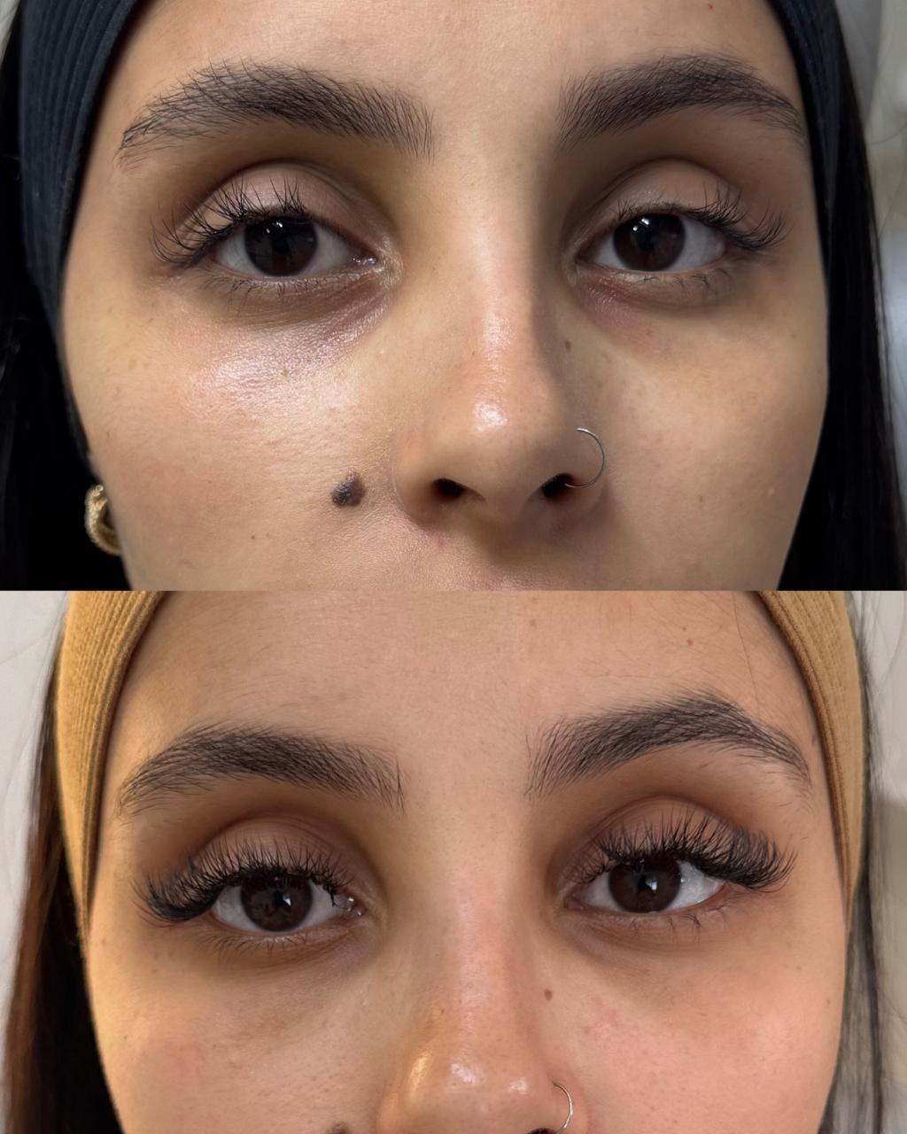 Antes e depois — Olheira com a Dra. Sabrina Waselkiu