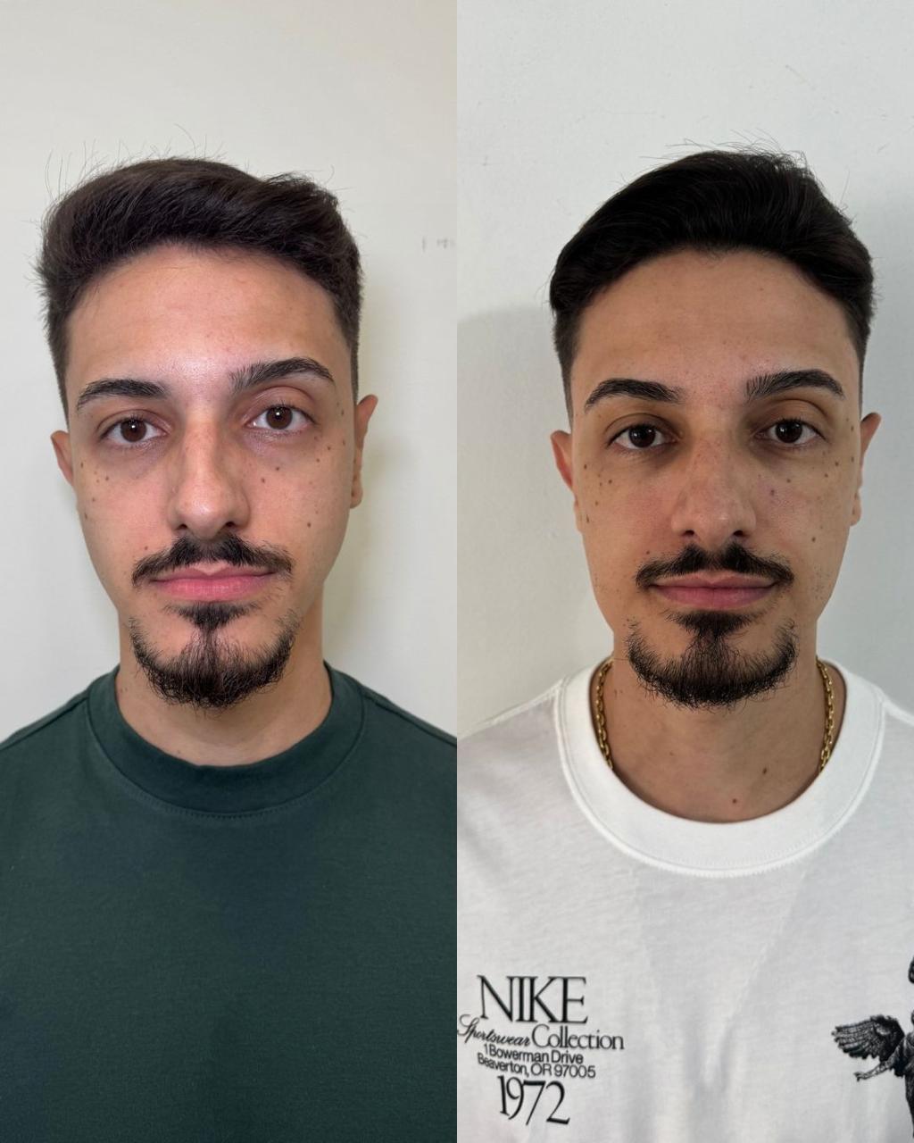 Antes e depois — Preenchimento Full Face com a Dra. Sabrina Waselkiu