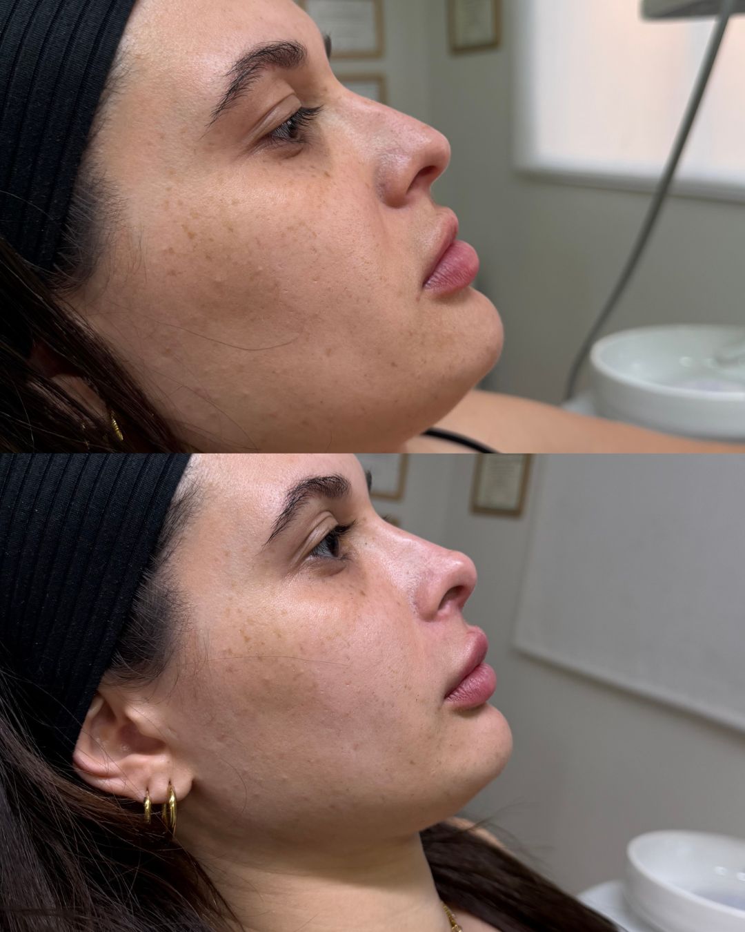 Antes e depois — Rinomodelação com a Dra. Sabrina Waselkiu