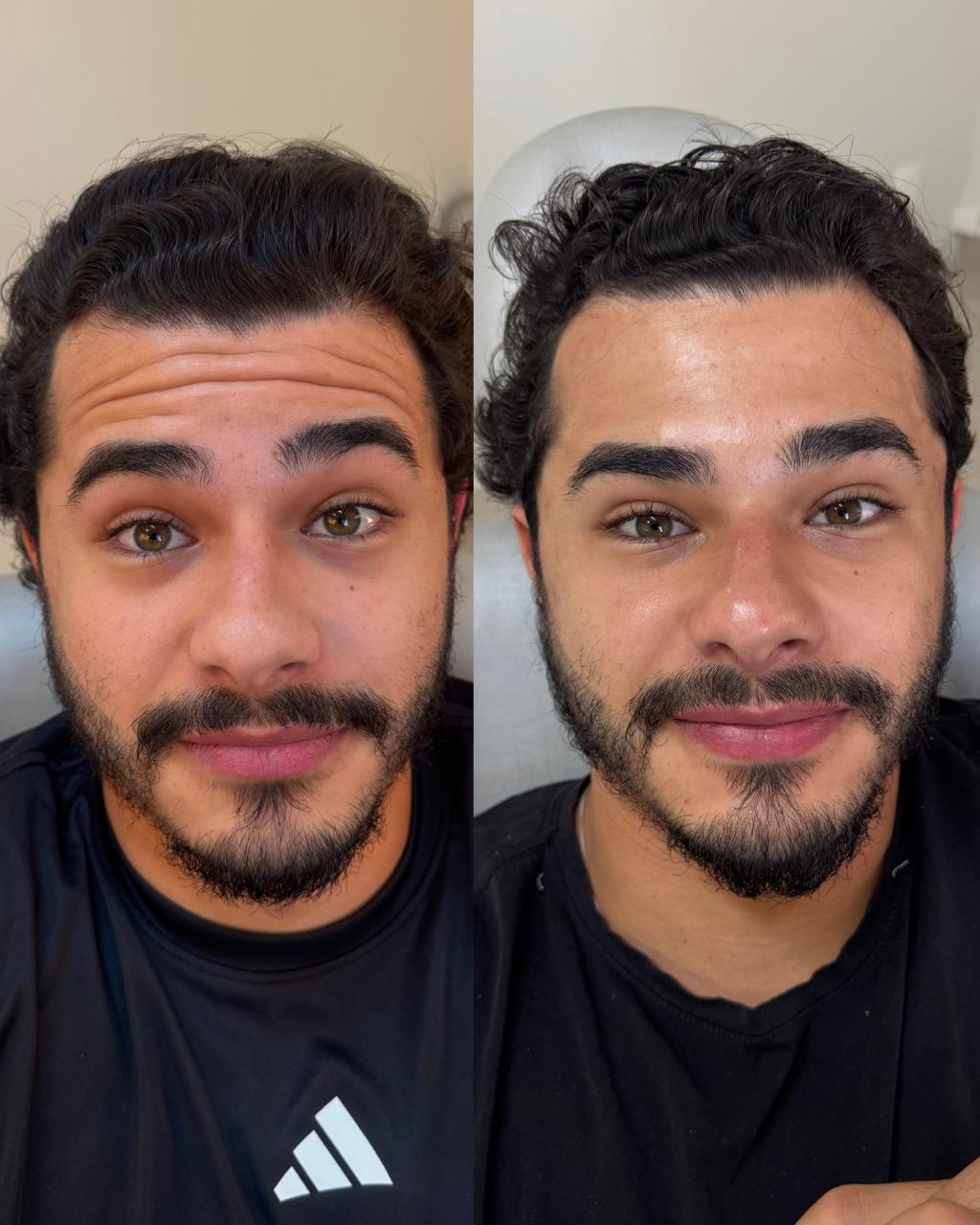 Antes e depois — Toxina Botulínica com a Dra. Sabrina Waselkiu