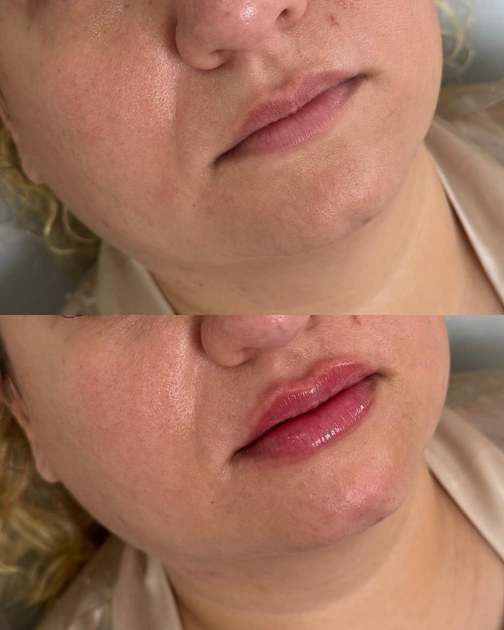 Antes e depois — Preenchimento Labial com a Dra. Sabrina Waselkiu