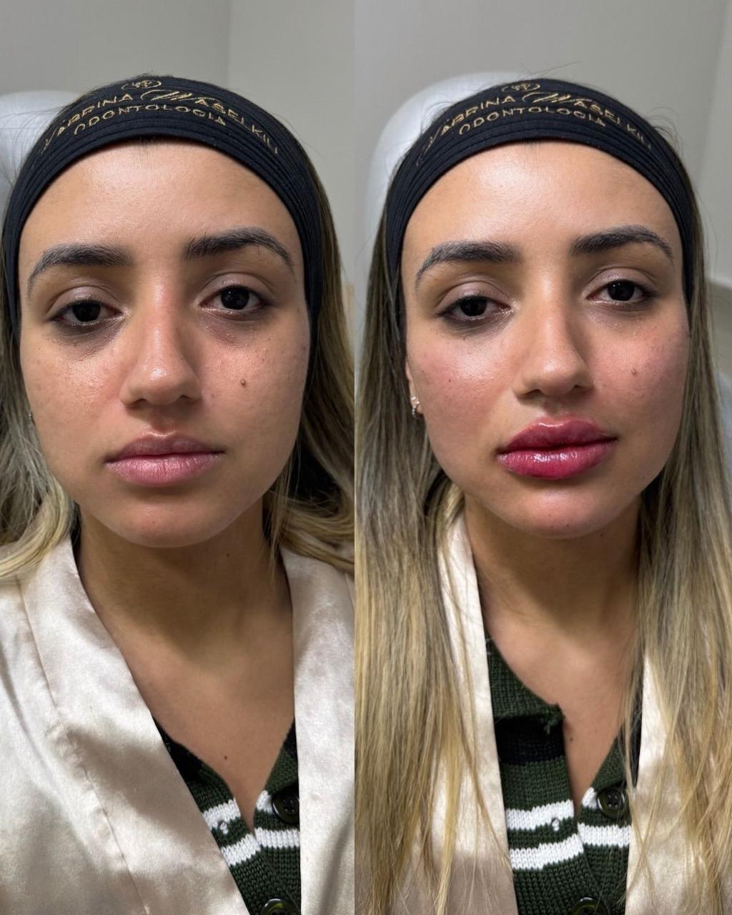Antes e depois — Preenchimento Full Face com a Dra. Sabrina Waselkiu