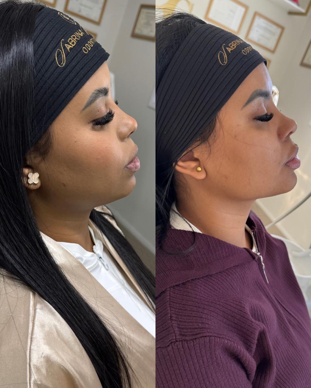 Antes e depois — Preenchimento Full Face com a Dra. Sabrina Waselkiu