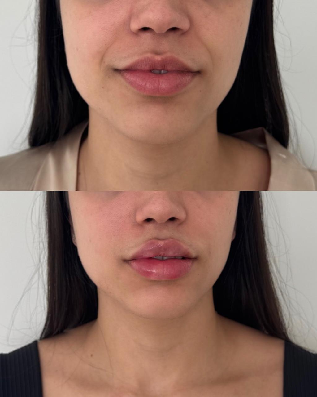 Antes e depois — Bigode chinês com a Dra. Sabrina Waselkiu