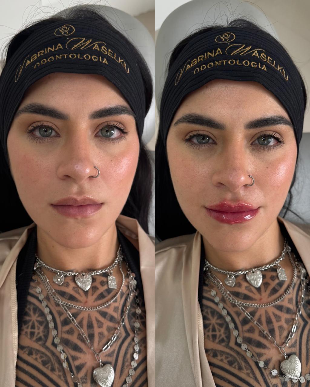 Antes e depois — Preenchimento Labial com a Dra. Sabrina Waselkiu