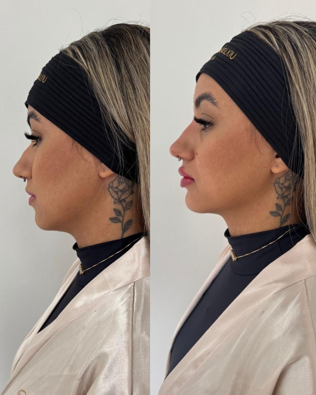 Antes e depois — Perfiloplastia com a Dra. Sabrina Waselkiu
