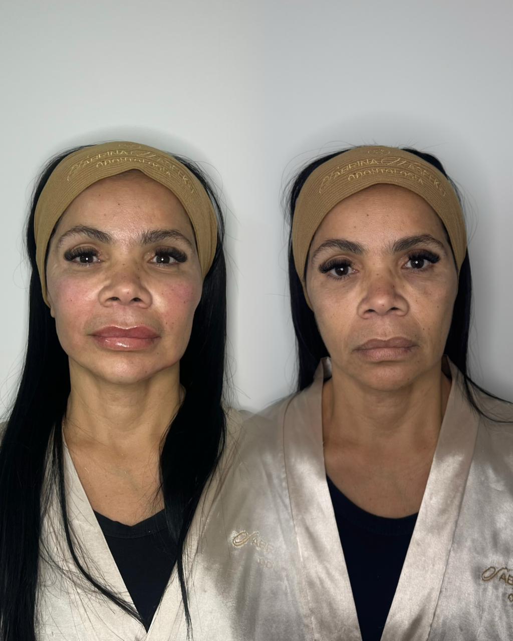 Antes e depois — Preenchimento Full Face com a Dra. Sabrina Waselkiu