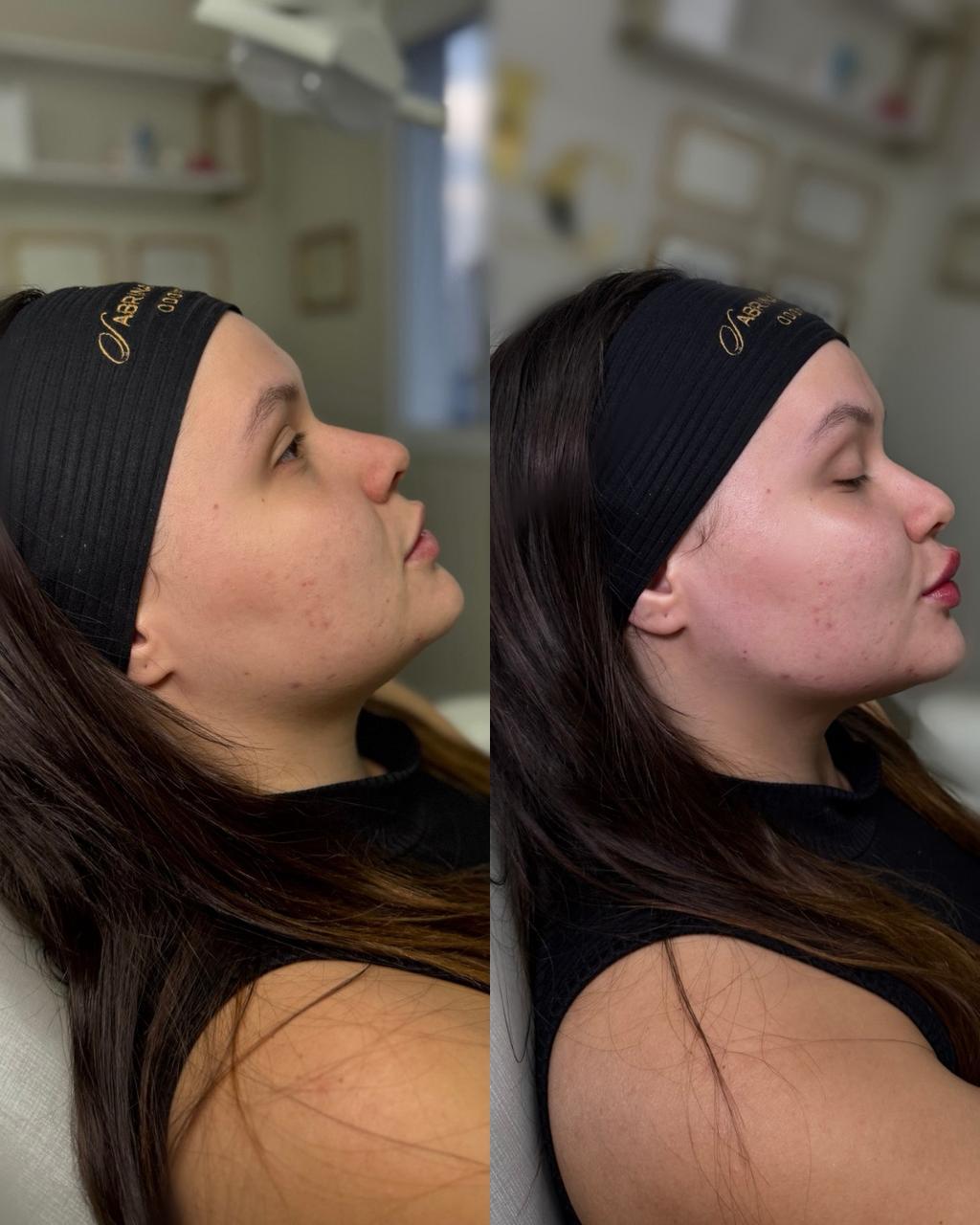 Antes e depois — Papada e contorno de mandíbula com a Dra. Sabrina Waselkiu