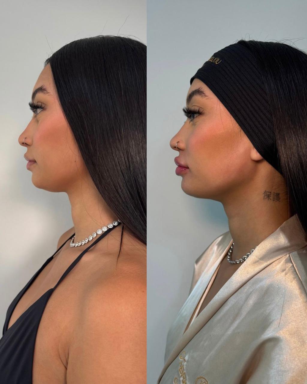 Antes e depois — Papada e contorno de mandíbula com a Dra. Sabrina Waselkiu
